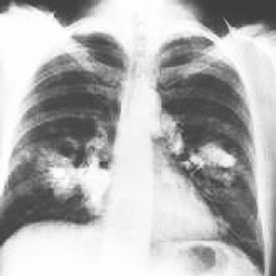 Lungenröntgen